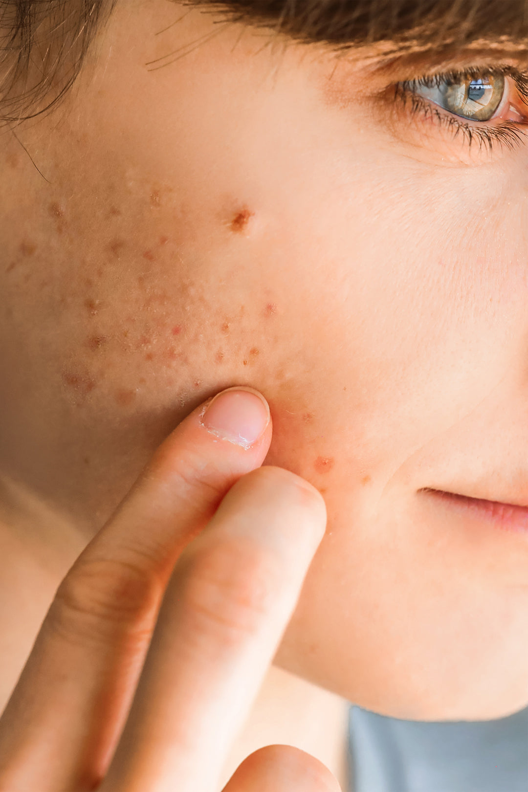 Is Tallow Good for Acne? The Truth Explained